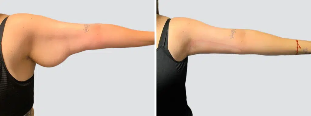 Arm Lift before and after - after