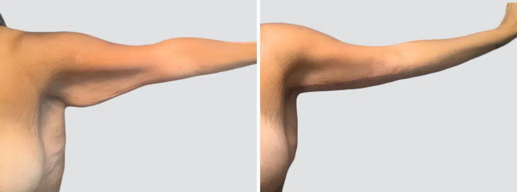 Arm Lift before and after - after