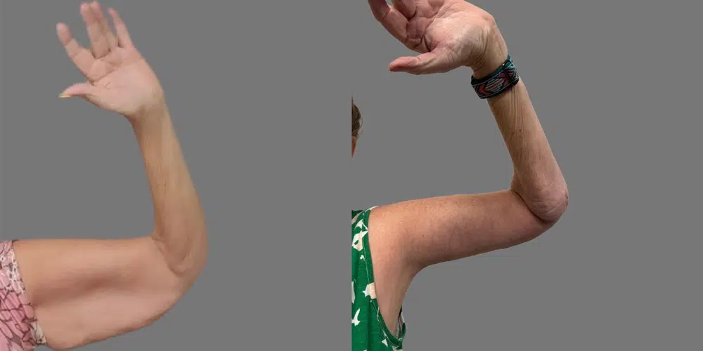 Arm Lift before and after - before