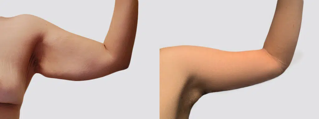 Arm Lift before and after - before
