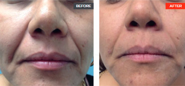 Breast Augmentation before and after - after