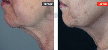 Breast Augmentation before and after - after