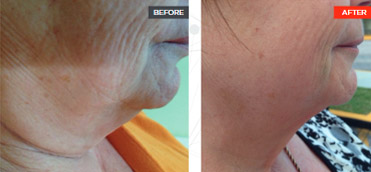 Breast Augmentation before and after - before