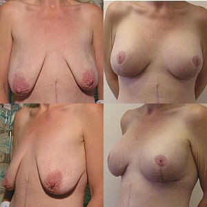 Breast Lift before and after - after