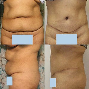 Tummy Tuck before and after - after