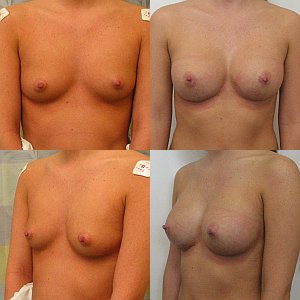 Breast Augmentation before and after - after