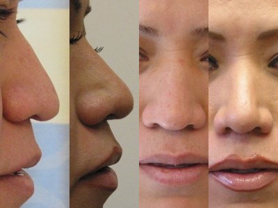 Liposuction before and after - after