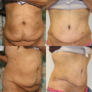 Tummy Tuck before and after - before
