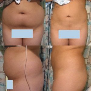 Liposuction before and after - before