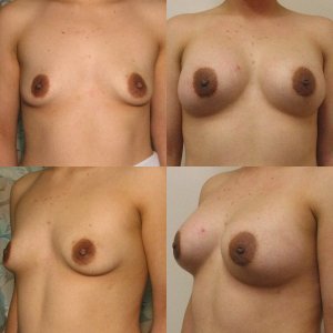 Breast Augmentation before and after - before