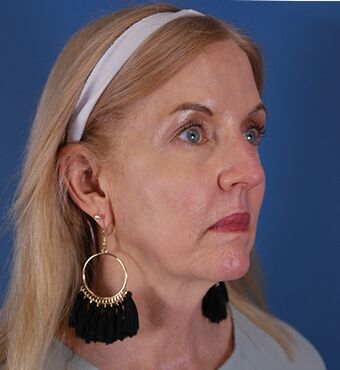 CO2 Laser Resurfacing before and after - after