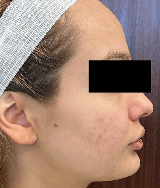 Accure Acne Laser Treatment before and after - after