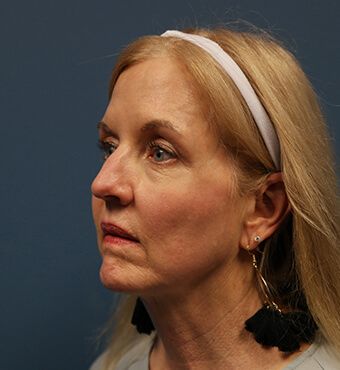 CO2 Laser Resurfacing before and after - after