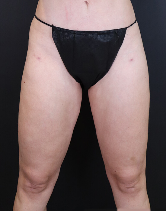 Vaser Liposuction before and after - after