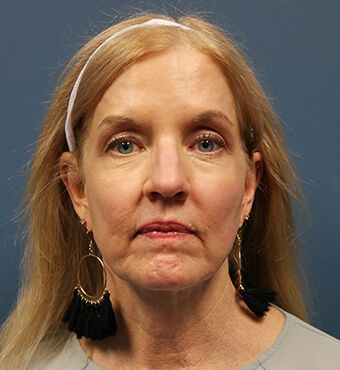 CO2 Laser Resurfacing before and after - after