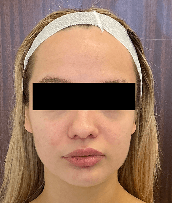 Accure Acne Laser Treatment before and after - after