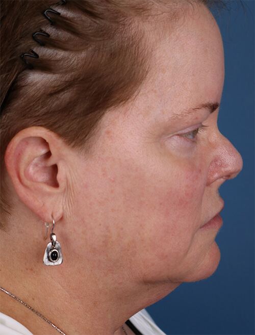 Ellacor before and after - after