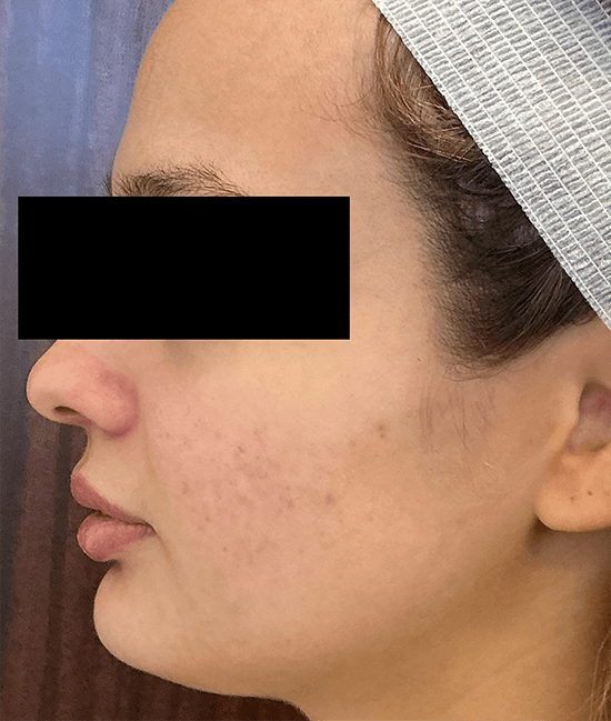 Accure Acne Laser Treatment before and after - after