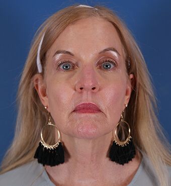 CO2 Laser Resurfacing before and after - after
