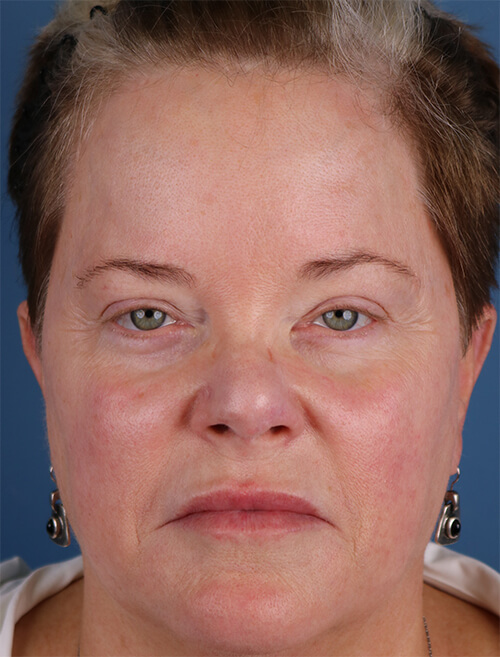 Ellacor before and after - after