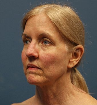 CO2 Laser Resurfacing before and after - before