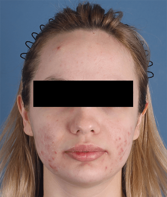 Accure Acne Laser Treatment before and after - before