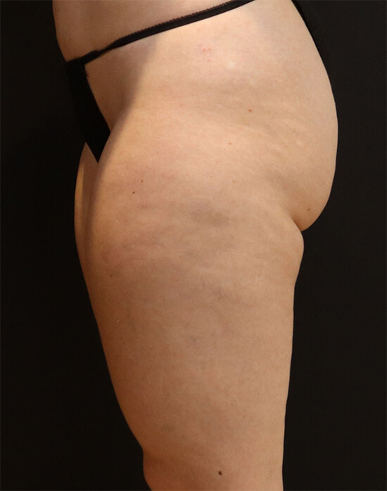 Vaser Liposuction before and after - before