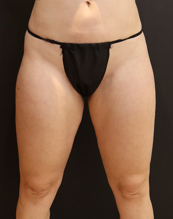 Vaser Liposuction before and after - before