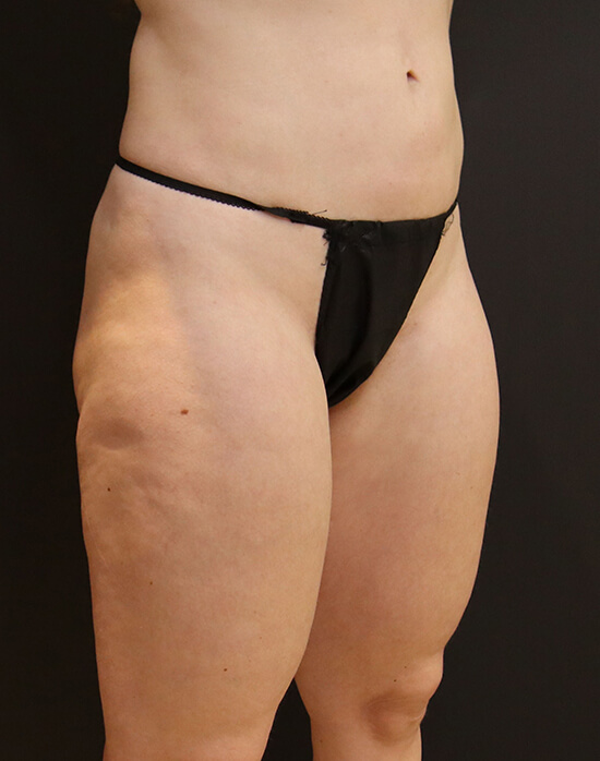 Vaser Liposuction before and after - before
