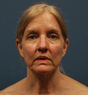 CO2 Laser Resurfacing before and after - before