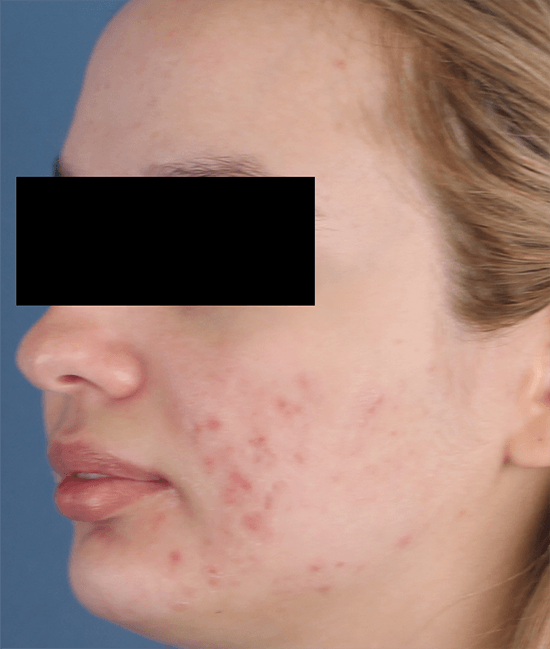 Accure Acne Laser Treatment before and after - before