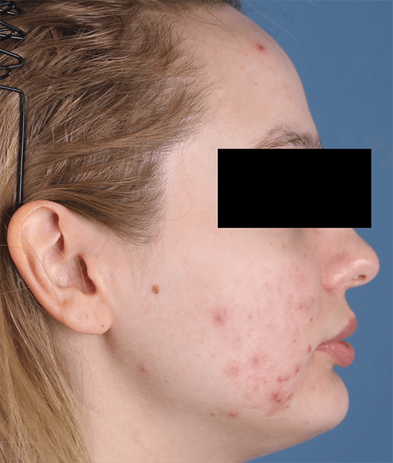 Accure Acne Laser Treatment before and after - before