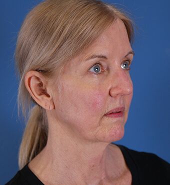 CO2 Laser Resurfacing before and after - before
