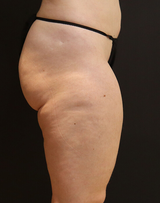 Vaser Liposuction before and after - before