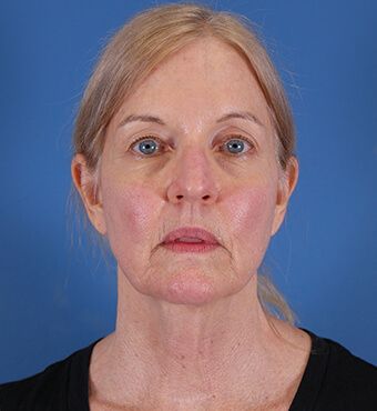 CO2 Laser Resurfacing before and after - before