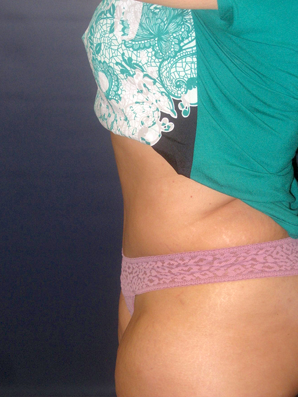 Tummy Tuck before and after - after
