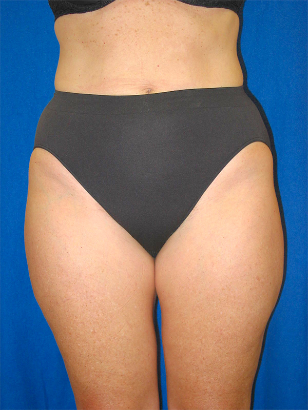 Liposuction before and after - after