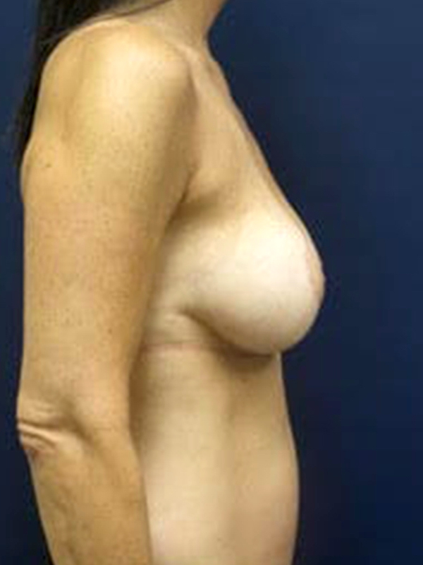 Breast Lift before and after - after