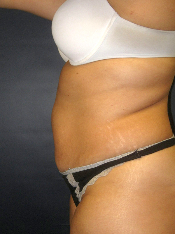 Tummy Tuck before and after - before