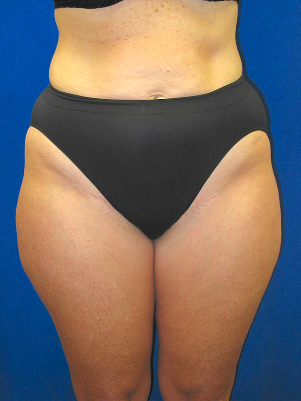 Liposuction before and after - before