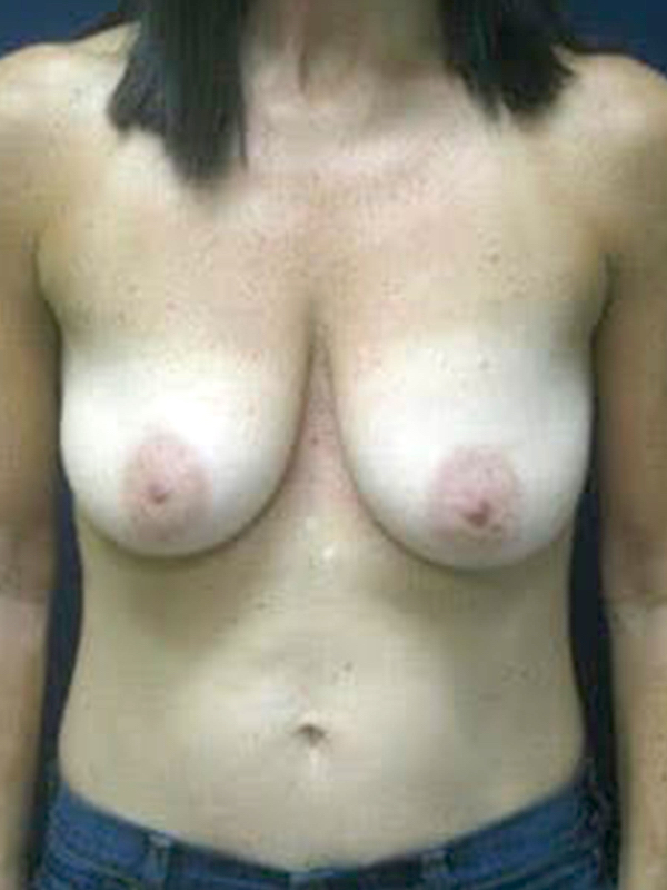 Breast Lift before and after - before