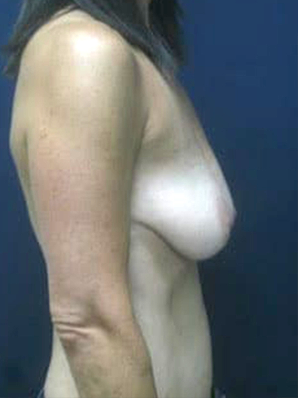 Breast Lift before and after - before