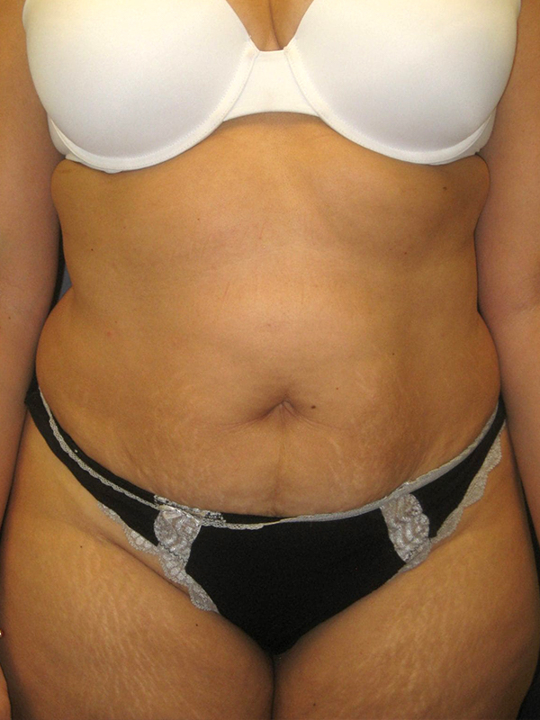 Tummy Tuck before and after - before