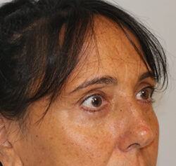 Blepharoplasty before and after - after