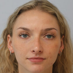 Rhinoplasty before and after - after