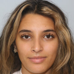 Rhinoplasty before and after - after