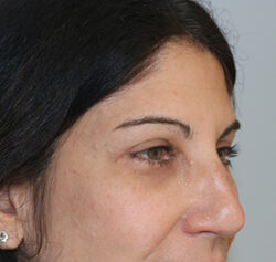 Blepharoplasty before and after - after
