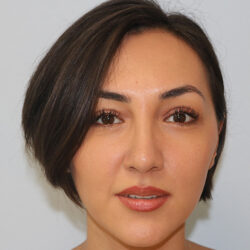 Rhinoplasty before and after - after