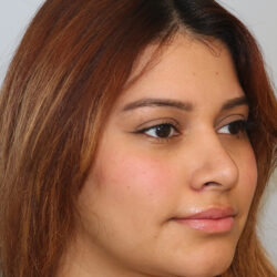 Rhinoplasty before and after - after