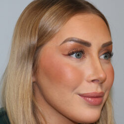 Rhinoplasty before and after - after